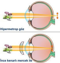 hipermetrop